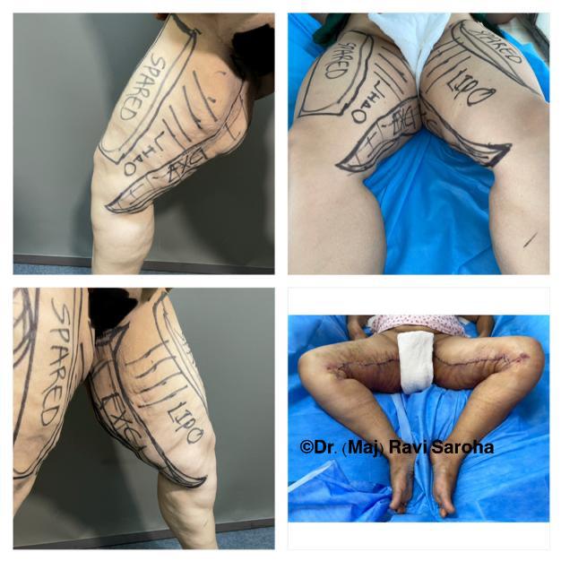 Body Surgery