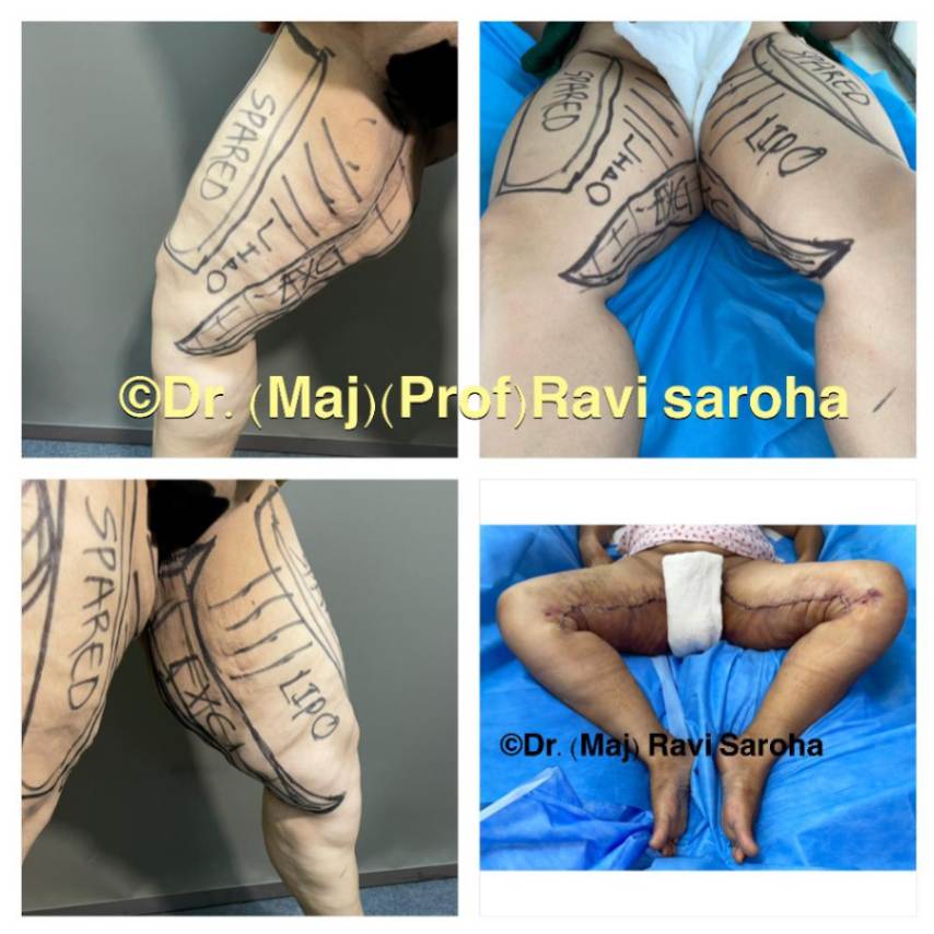 Body Surgery