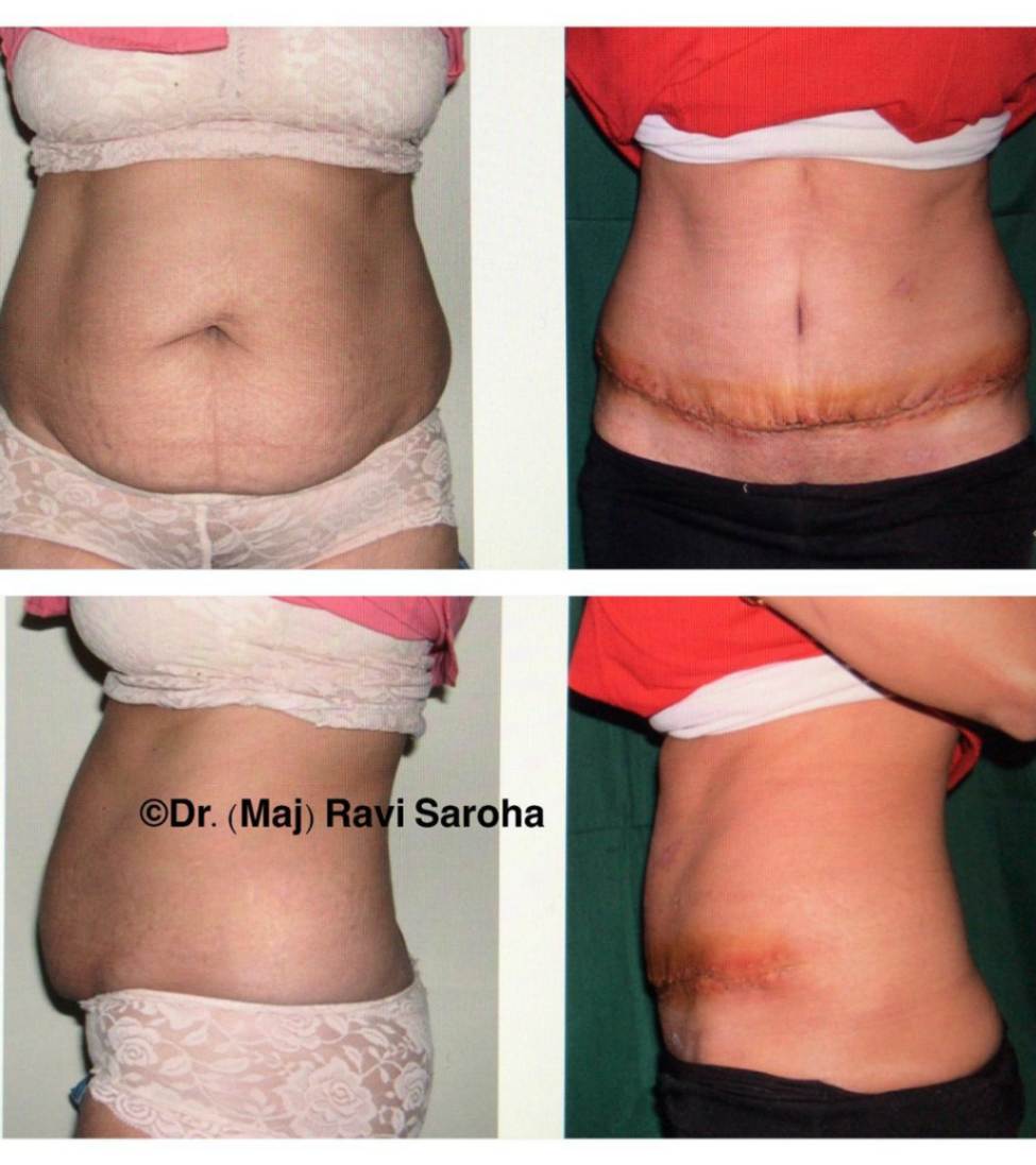 Body Surgery