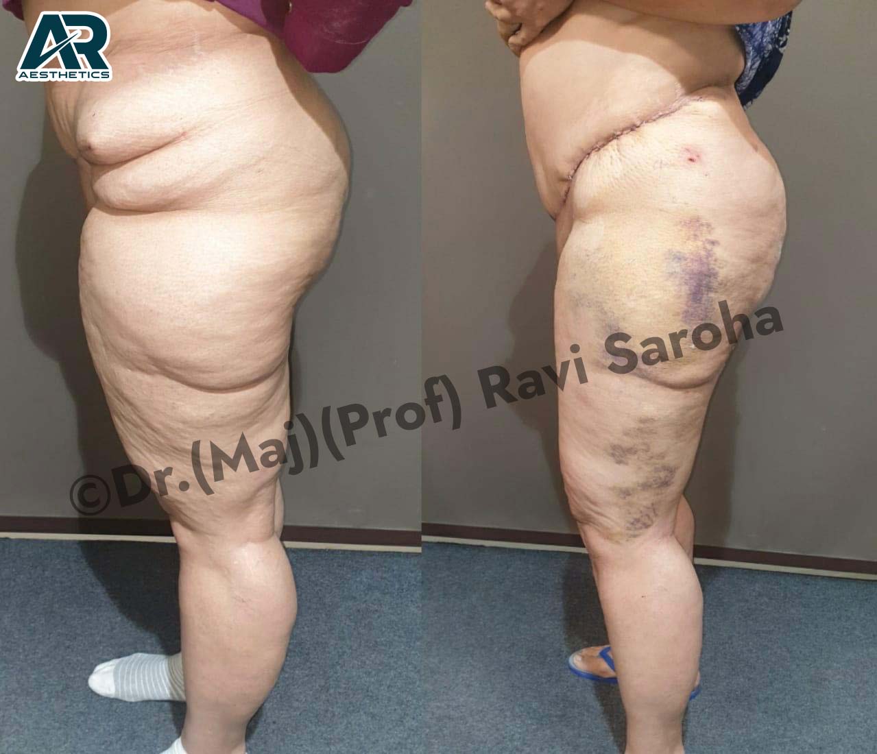 Body Surgery