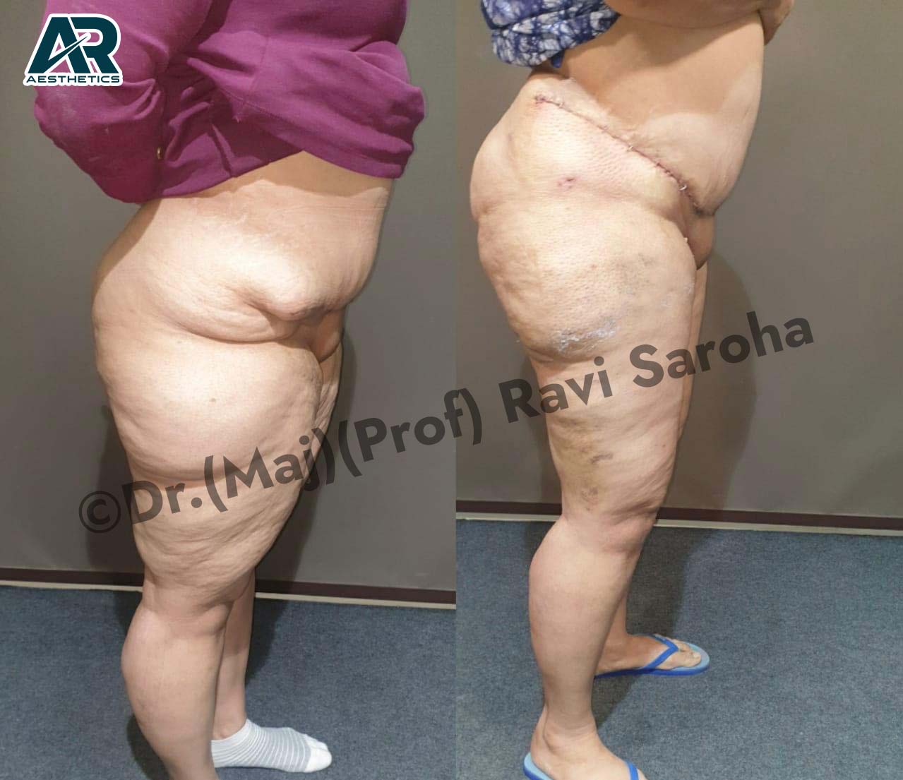 Body Surgery