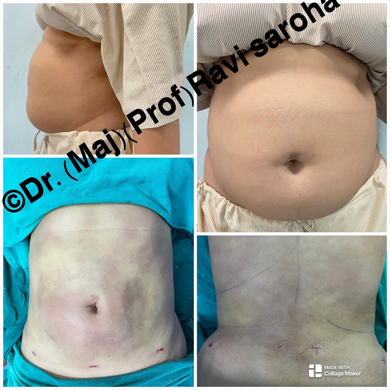 Body Surgery