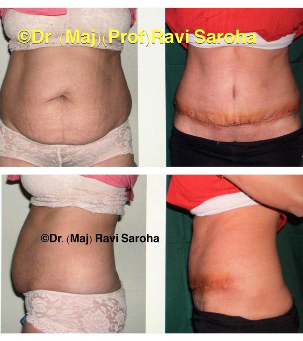 Body Surgery