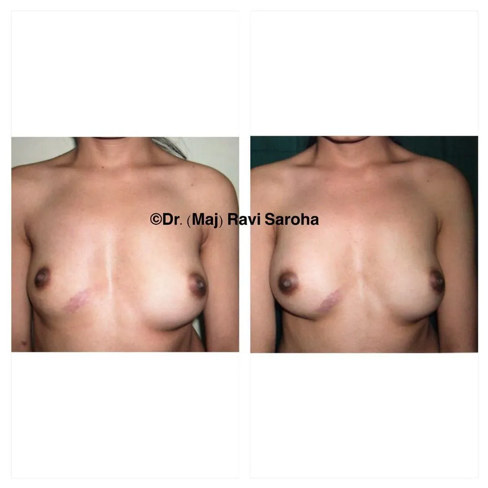 Breast Surgery procedure