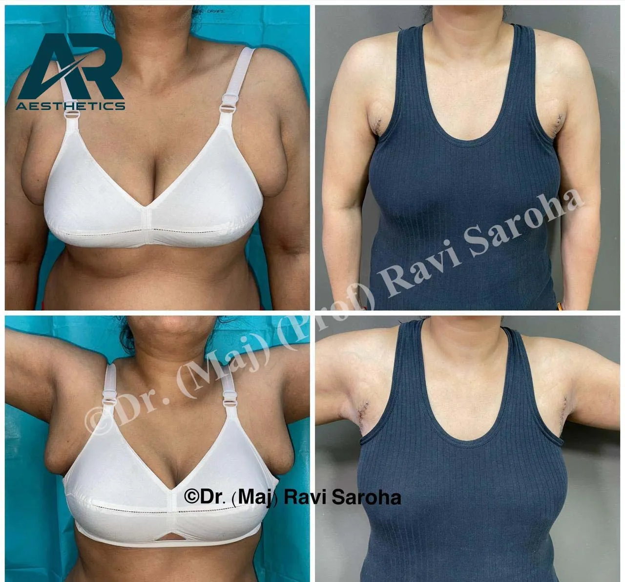 Breast Surgery procedure