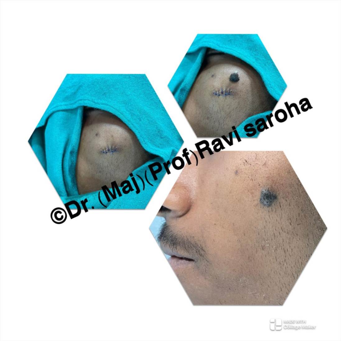 Facial Surgery