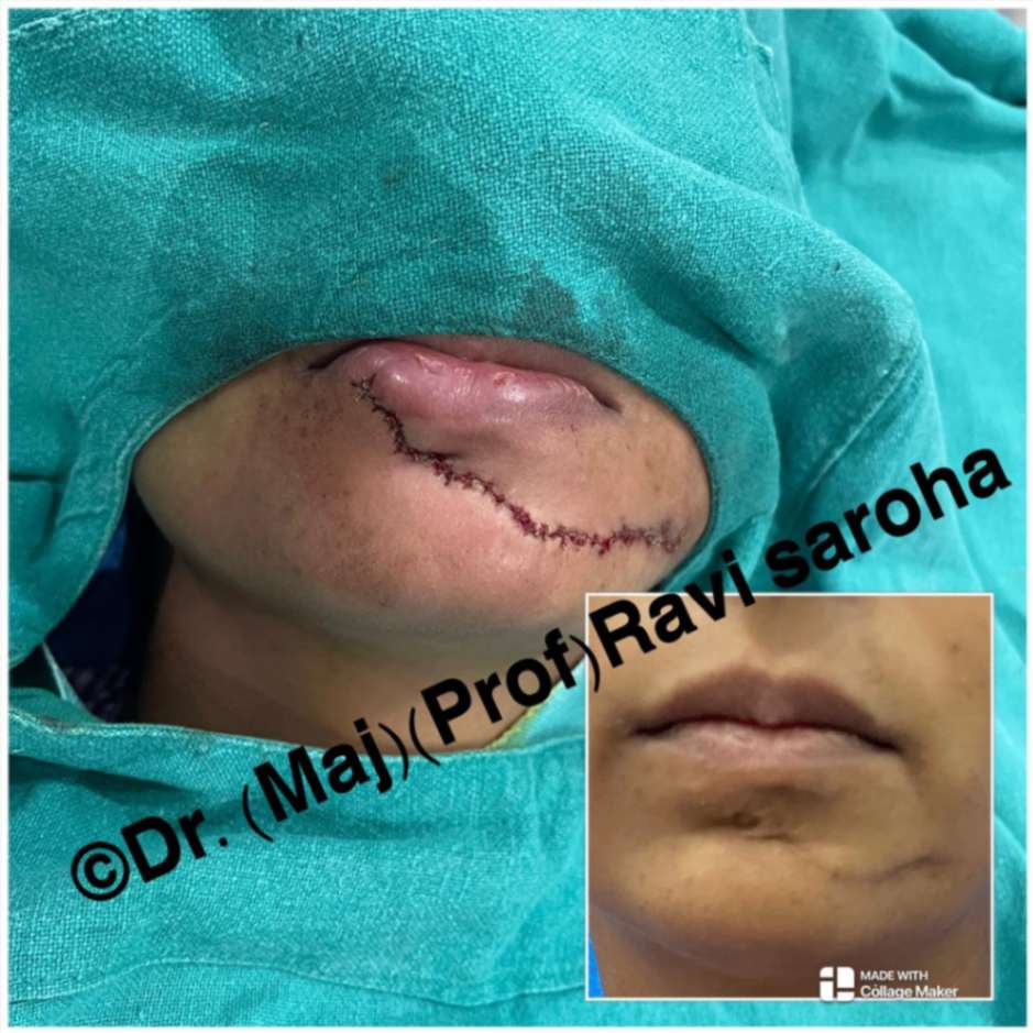 Facial Surgery