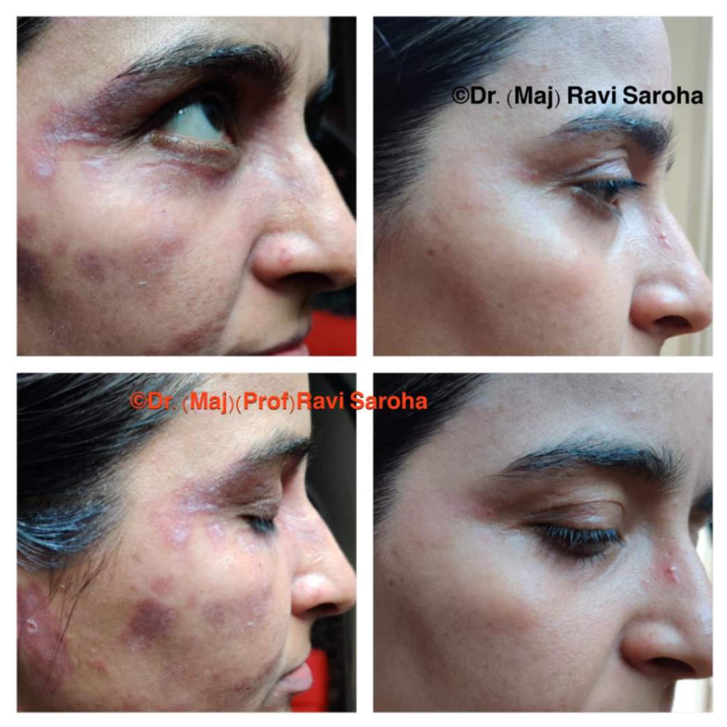 Rhinoplasty