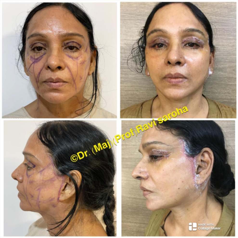 Facial Surgery