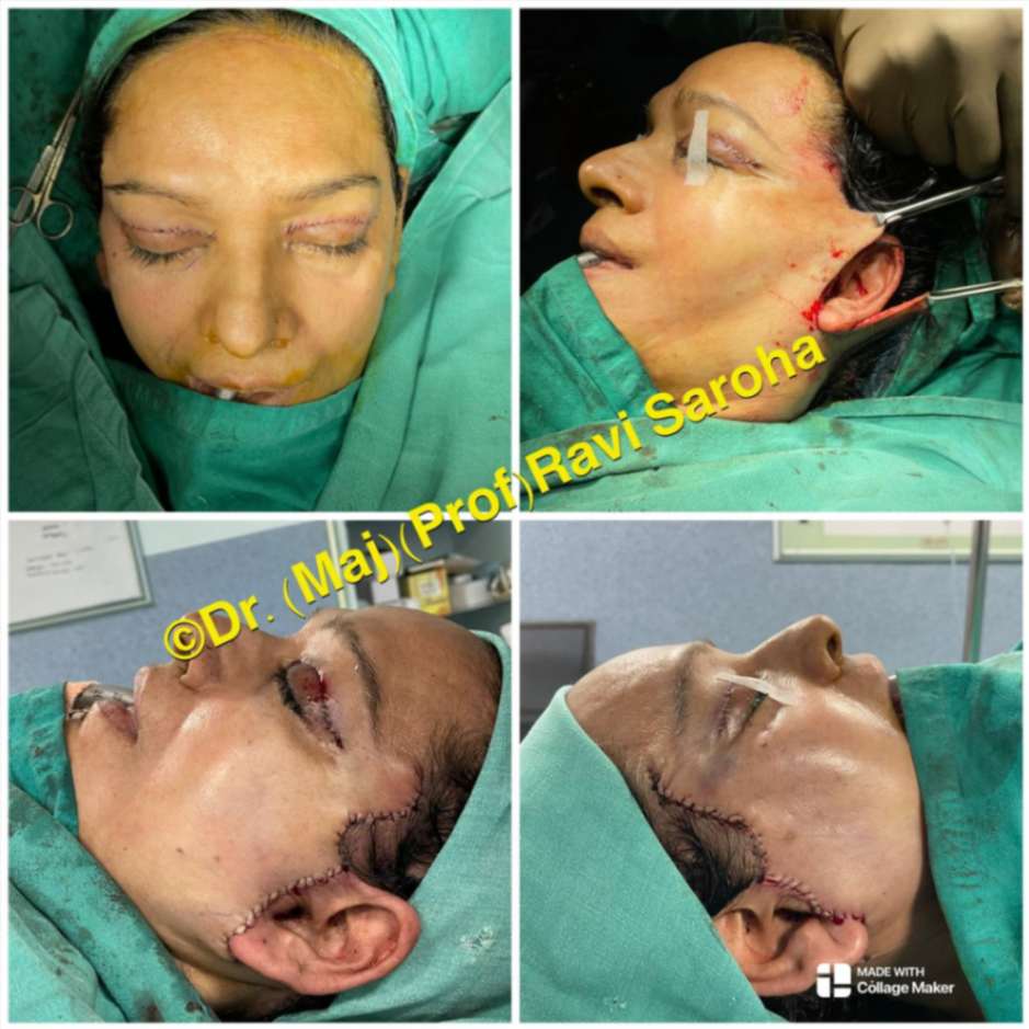Facial Surgery