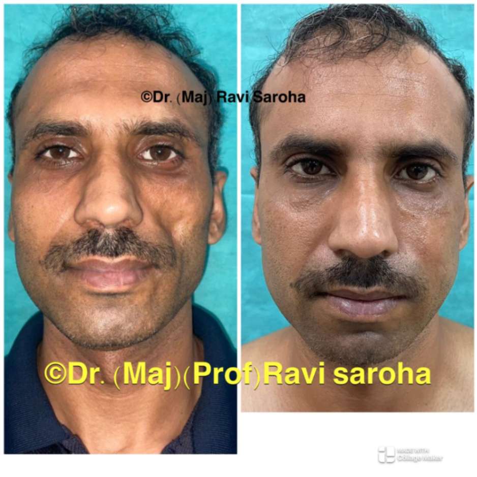 Facial Surgery