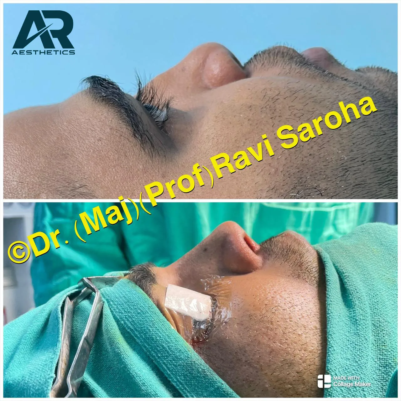 Rhinoplasty