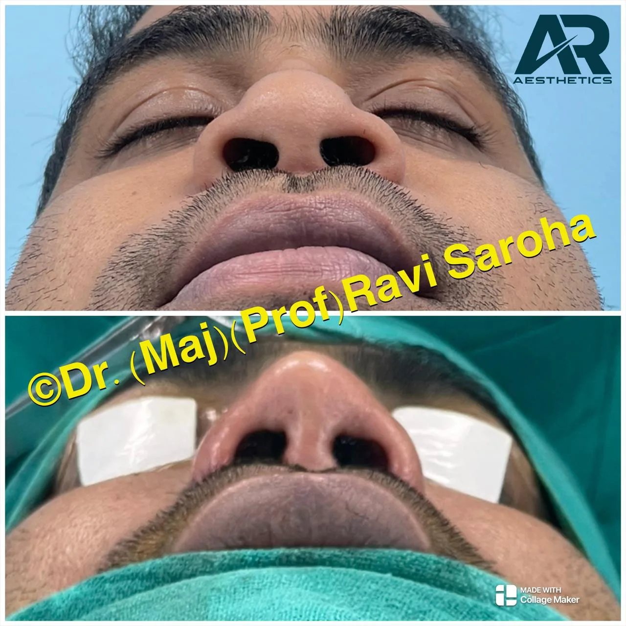 Rhinoplasty